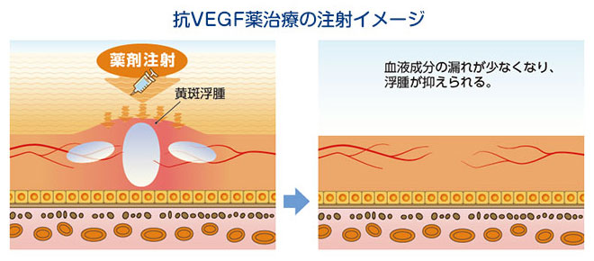 抗VEGF薬治療の注射イメージ