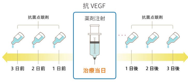 抗VEGF治療（硝子体内注射）